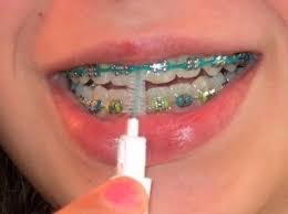 But It S Fine You Re Fine Everything S Fine Just Concentrate On How Great You Re Going To Look Afterwards Getting Braces Teeth Braces Dental Braces