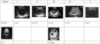 Fluid collection with a split wall fluid collection with septa heterogenous echo patterns. Expert Consensus For The Diagnosis And Treatment Of Cystic And Alveolar Echinococcosis In Humans Sciencedirect