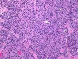 Image result for Glomus tumor