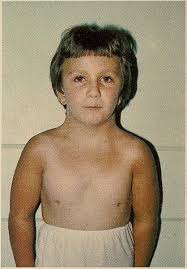 Image result for Webbed Neck