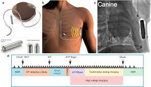 Going through airport security can be confusing even for people without an implanted device. The Future Of The Implantable Cardioverter Defibrillator Springerlink