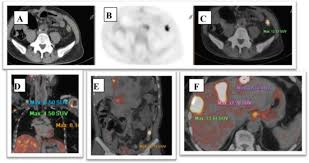 Imaging tests usually can't tell if a change has been caused by cancer. Can Pet Ct Detect Recurrence In Post Operative Colorectal Carcinoma Patients With Elevated Cea Level Egyptian Journal Of Radiology And Nuclear Medicine Full Text