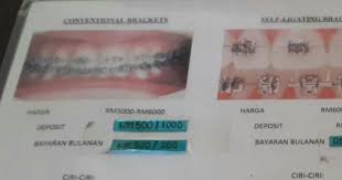 Borang permohonan braces kerajaan 2020. Amoi Berhijab Pengalaman Pakai Braces A K A Pendakap Gigi Di Dr Faiz Dental Surgery