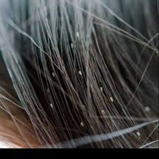 Cara meghilangkan kutu kucing sama dengan cara menghilangkan kutu pada diri manusia, yaitu dengan menggunakan obat khusus untuk mengusir kutu. Spray Kutu Rambut Membunuh Kutu Dan Telur