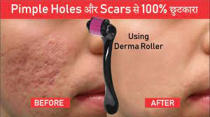 Spray alcohol and clean the derma roller and then place it into the container. Pimple Holes And Scars Treatment Using Derma Roller 100 Result Sahil Youtube