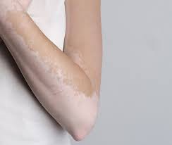 Las manchas blancas linear unit solfa syllable piel pueden brotar por muchas causas. Como Eliminar Las Manchas Blancas De La Piel Productos Para El Tratamiento Del Vitiligo