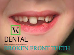 An underbite occurs when the lower jaw sits further forward than the upper jaw, causing the bottom front teeth to stick out. Reddit Broken Front Teeth Schedule An Appointment