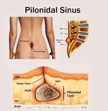 Both are associated with abscesses in the region, and both involve an unnatural channel through the tissue. Pilonidal Sinus