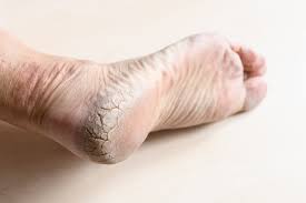 Image result for Anhidrosis