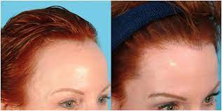 According to the united states national library of medicine, the scalp of a human contains about 100,000 hairs and a person could lose up to 100 hairs per day. A Guide To Preventing Stress Related Hair Loss Kerotin