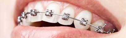 Self-Ligating Braces Chino Hills La Habra - Gire Orthodontics