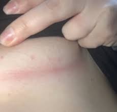 Image result for heat rash under breasts