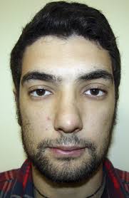 Mandibular Resection and Reconstruction in the Management of Extensive  Ameloblastoma