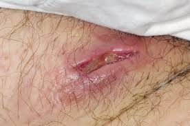 Image result for Perianal Abscess