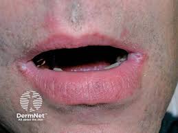 Image result for Angular Cheilitis