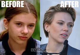 This is your profile url. Scarlett Johansson Plastic Surgery Breast Reduction Before After