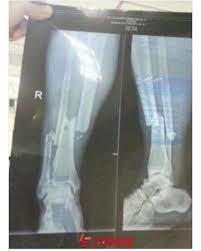 Fa cup 4th round replay. Wan On Twitter Xray Demba Ba Punya Kaki Lps Injured Holycow Syafakallah Bro