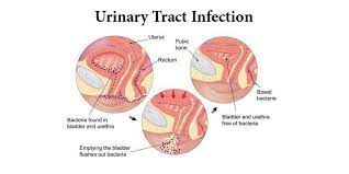 Epidemiology, mechanisms of infection and treatment options. Best Urinary Tract Infections Treatment Diagnosis India Rg Hospital