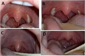 Image result for Tonsillectomy