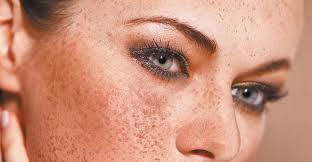 This is an early form of melanoma with an excellent prognosis. Melanoma A Skin Cancer Medika Life Skin Cancers