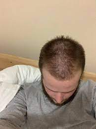 By age 20, about 20% of men have at least some visible hair loss. I M 20 Years Old How Bad Is My Hair Loss Bald
