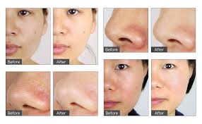 La microdermoabrasión es una técnica moderna cuyo objetivo es rejuvenecer la piel. Amazon Com Unoisetion Diamond Dermabrasion Machine 2 In 1 Diamond Microdermabrasion Dermabrasion Professional For Facial Care Beauty Salon Home Microdermabrasion Machine For Blackhead Skin Debris Removal Beauty