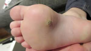 Ein hautarzt untersucht neue muttermale. Hausmittel Gegen Warzen Muttermale Oder Altersflecken Welche Wirklich Helfen Kolner Stadt Anzeiger