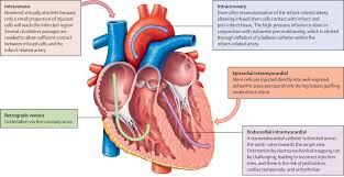 Image result for Myocardial Infarction Stabilization