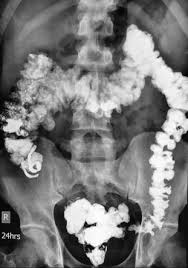 Duplex Appendix Radiology Reference Article Radiopaedia Org Epididymal appendices, also known as appendix of the epididymis or appendix epididymis, are an testicular appendage found at the head of the epididymis 1. duplex appendix radiology reference