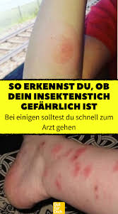Wenn nach dem stich einer biene, wespe oder hornisse die haut am ganzen körper zu jucken beginnt, die augenlider anschwellen oder das atmen schwerfällt, müssen sie unverzüglich einen notarzt rufen (telefon 112), weil es sich um einen allergischen schock handeln. Diese Liste Hilft Dir Zeckenbisse Wespenstiche Und Hautrotungen Anderer Insekten Besser Zu Erkennen Insektenstich Gesundheit Und Wohlbefinden Gesundheitsfragen