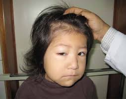 obstrucción intestinal por tricobezoar: síndrome de Rapunzel. Reporte del  primer caso pediátrico preescolar