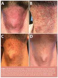 I had already shaved 2 days after laser, so i was worried i had effected my results. Folliculitis Induced By Laser Hair Removal Proposed Mechanism And Treatment Jcad The Journal Of Clinical And Aesthetic Dermatology
