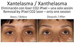 Image result for xantelasma