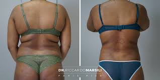 Liposuzione Liposcultura Tridimensionale Dr Marsili