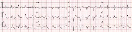 Typical vt (in contrast to fascicular vt) starts in. Svt With Aberrancy Or Ventricular Tachycardia Acls Medical Training