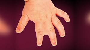 Image result for Syndactyly