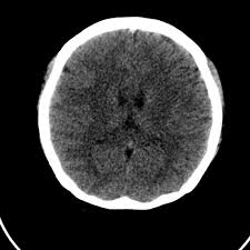 Cerebral venous thrombosis in the absence of headache. Cerebral Venous Hemorrhagic Infarct From Venous Sinus Thrombosis Radiology Case Radiopaedia Org