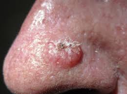 Here&#x27;s what to watch for. Non Melanoma Skin Cancer Cancer Therapy Advisor