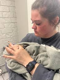 Scabby patches around a baby's eyes and face