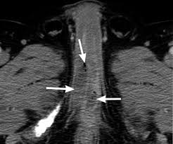 Joint trust clinical procedure for the management of foreign body in urethra / bladder v1.1; Fournier Gangrene Role Of Imaging Radiographics