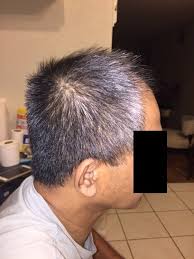 Finasteride stops hair loss in many patients; Is It Worth It To Get A Hair Transplant Without Finasteride Photo