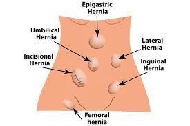 Hernia Surgery Hernia Repair Treatment Mount Elizabeth Hospitals