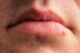If you see one above or. How To Identify A Herpes Cold Sore Vs Pimple Expert Advice Allure