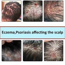 Em geral, quando a lesão se localiza na orla do couro cabeludo, costuma ser psoríase. 30ml Dermovate Couro Cabeludo Aplicacao 0 05 Clobetasol Eczema Psoriase Que Afeta O Couro Cabeludo Creme Do Couro Cabeludo Patches Aliexpress