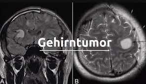 Schockdiagnose Gehirntumor Symptome Arten Risiken Und Behandlungsmethoden Medizin Fitness Ernahrung