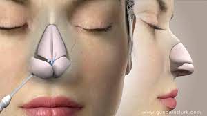 Rhinoplasty Nose Job Video Animation Guncel Ozturk Md Drgo Youtube