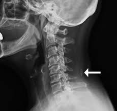 Medical definition of ligamentum nuchae: Sesamoid Ossicle Of The Nuchal Ligament The Spine Journal