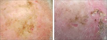 He is an associate profess. Topical Imiquimod Clears Invasive Melanoma Mdedge Dermatology