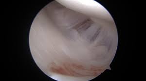 Hagl đã biết đá phòng ngự. Humeral Avulsion Glenohumeral Ligament Hagl Shoulder Elbow Orthobullets