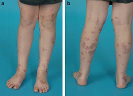 Small vessel vasculitis is the most common form of vasculitis affecting arterioles and venules. Case Report Of A Child With Henoch Schonlein Purpura And Complications Of Laser Treatment Journal Of Plastic Reconstructive Aesthetic Surgery